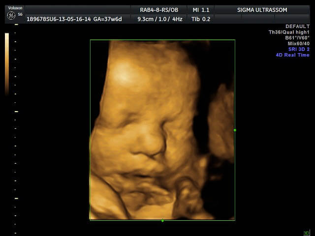 Sinais de ooforite pela ultrassonografia Dr Pixel